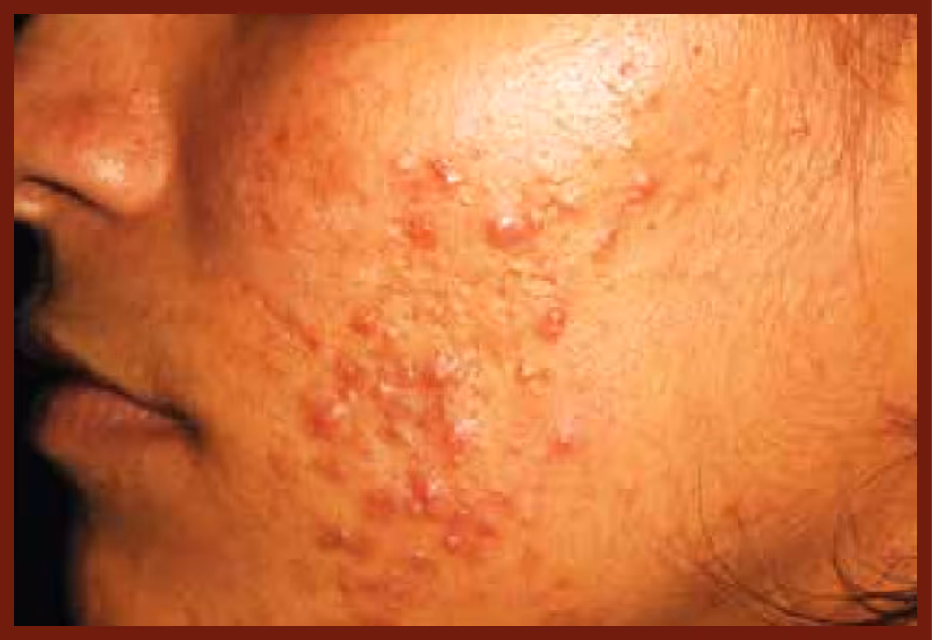 Illustration related to Acne