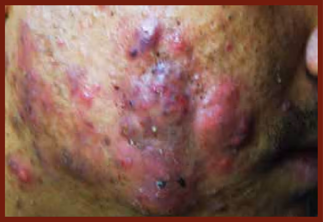 Illustration related to Acne