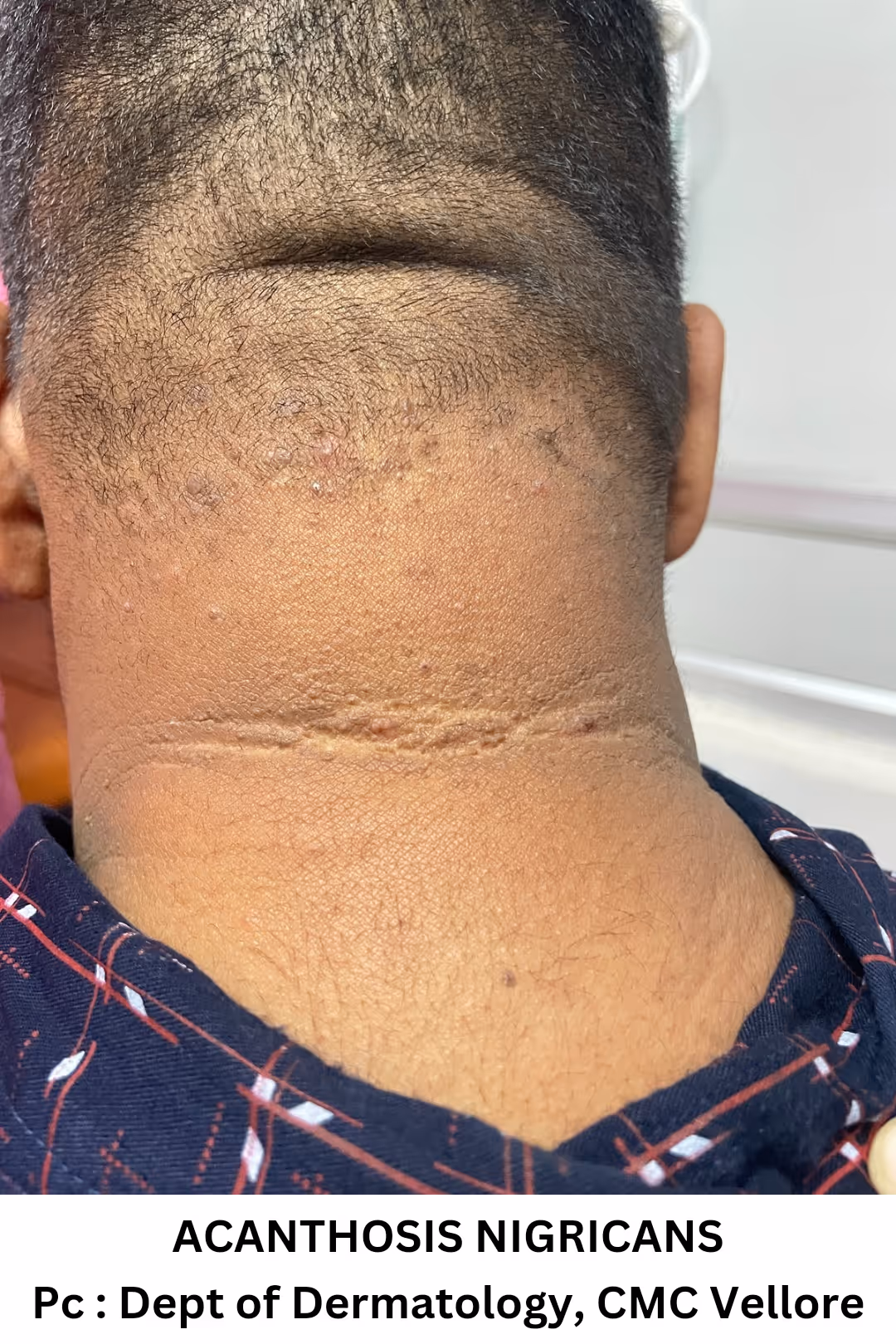 Illustration related to Acne