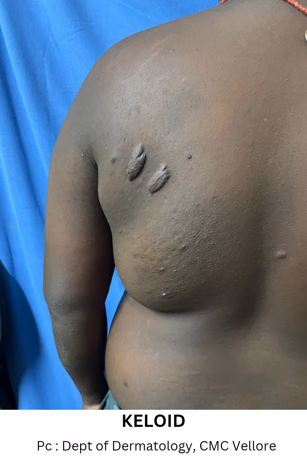 Illustration related to Keloid Surgery