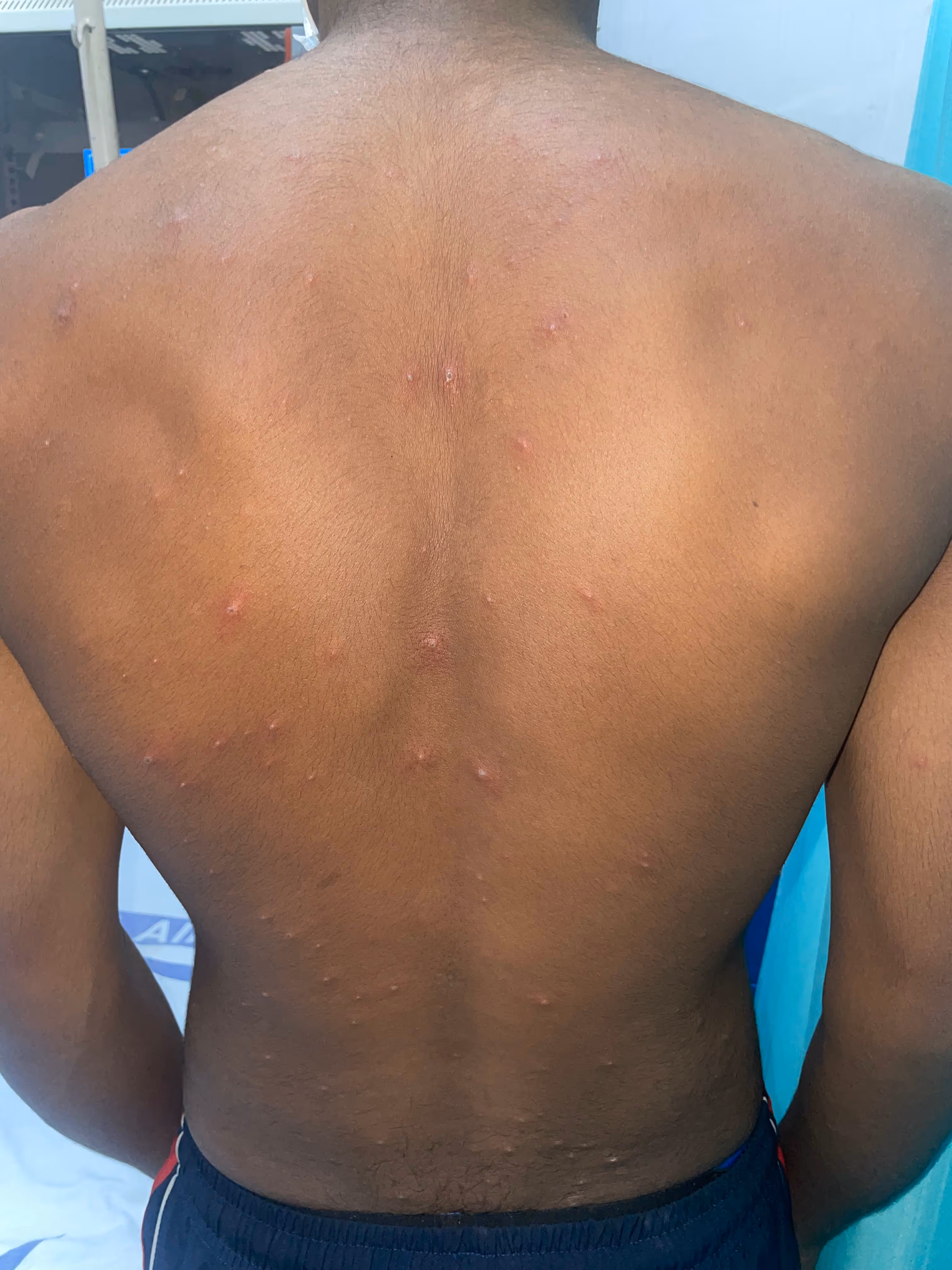 Illustration related to Chicken Pox