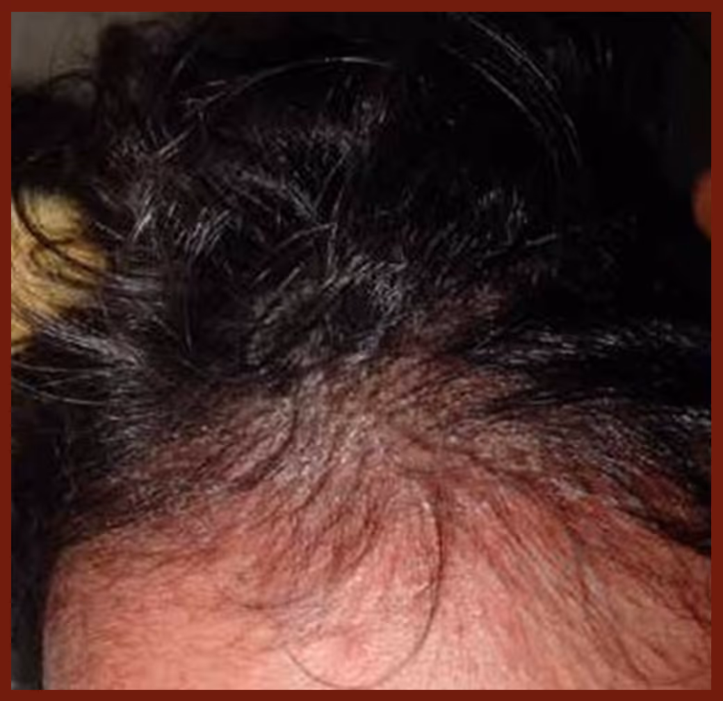 Illustration related to Dandruff