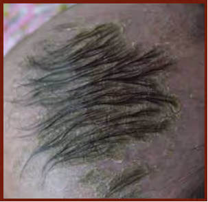 Illustration related to Dandruff