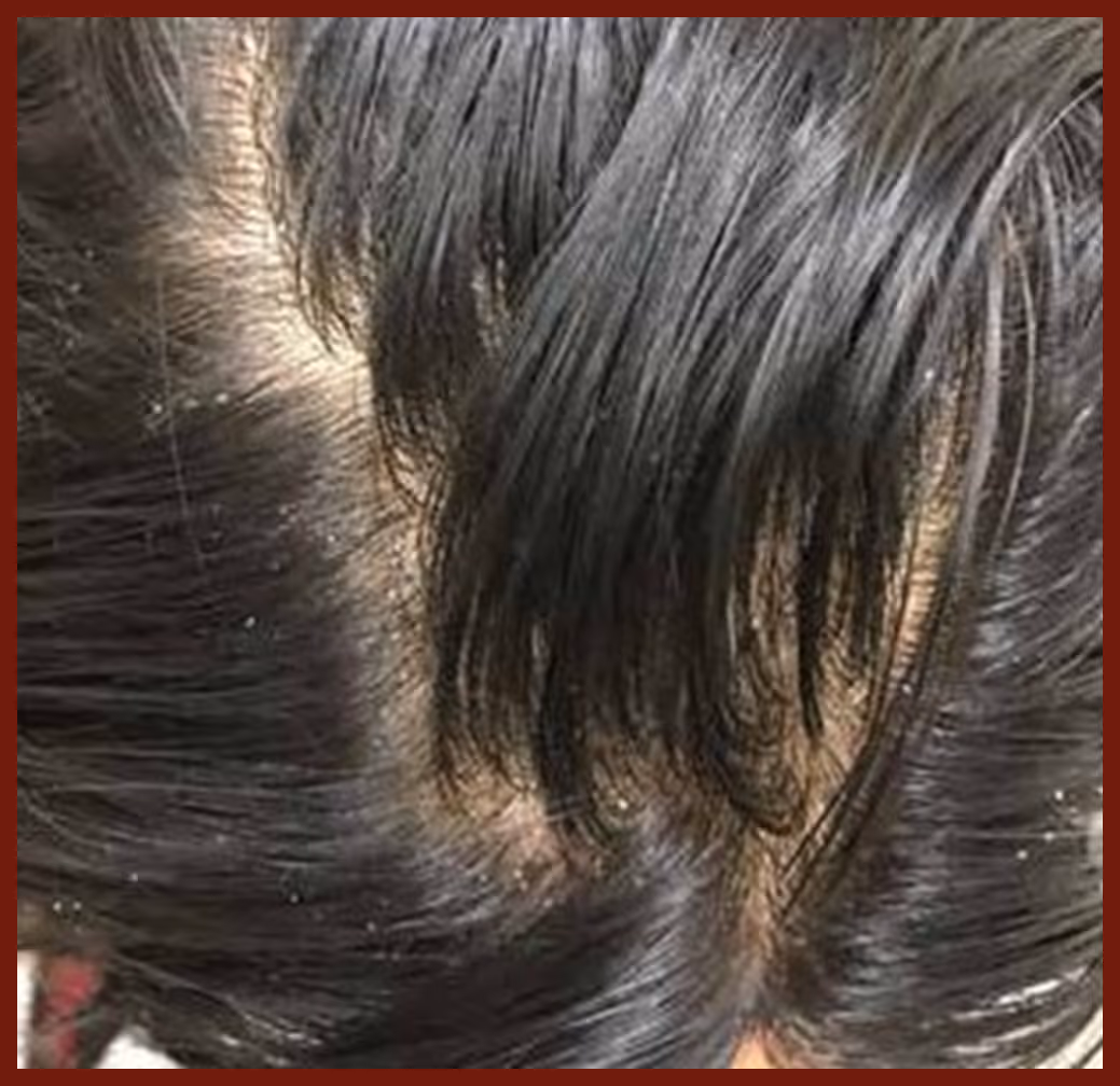 Illustration related to Dandruff