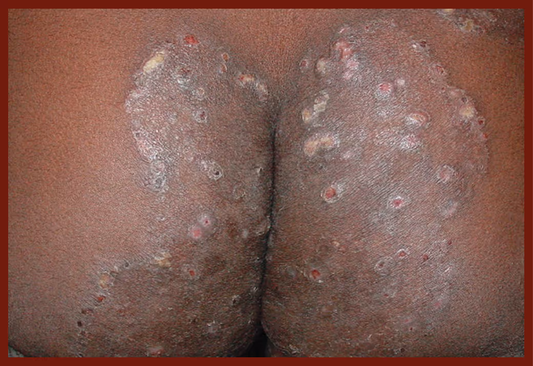 Illustration related to Fungal Skin infection