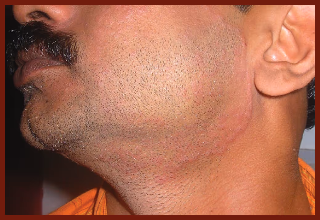 Illustration related to Fungal Skin infection