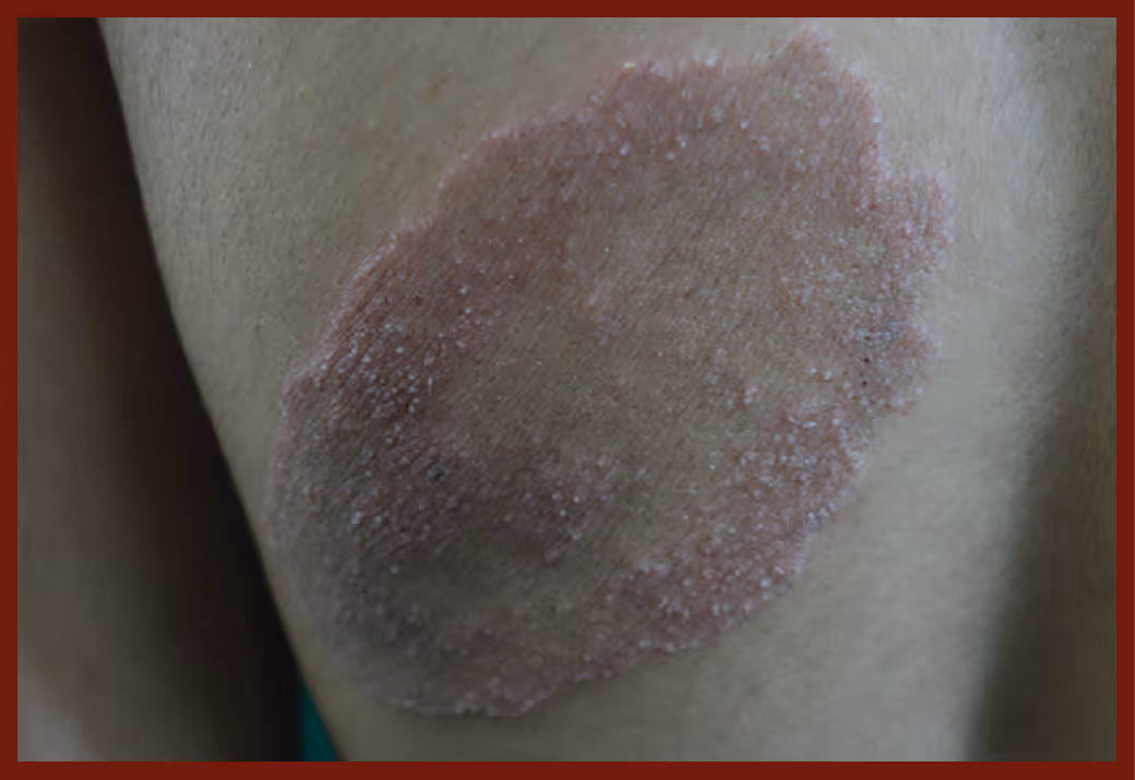 Illustration related to Fungal Skin infection