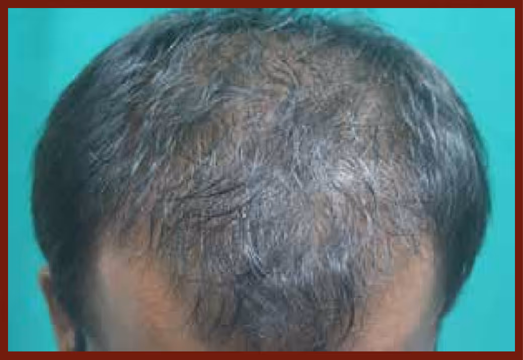 Illustration related to Hair Loss