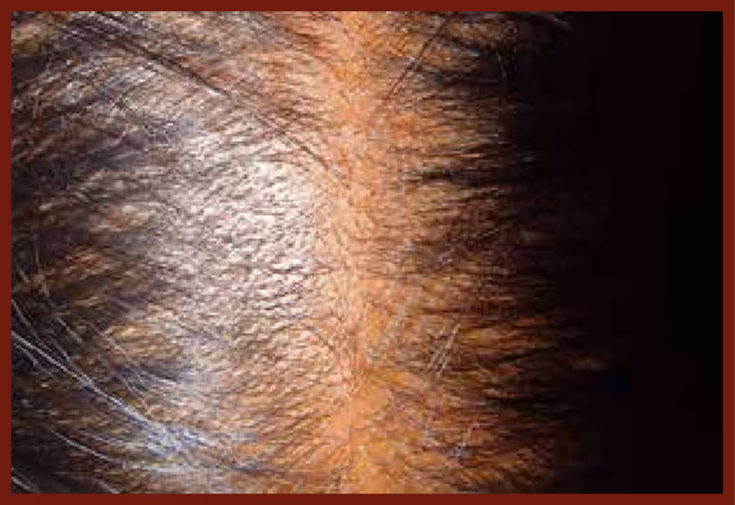 Illustration related to Alopecia Areata