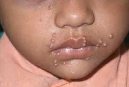 Illustration related to Molluscum Contagiosum