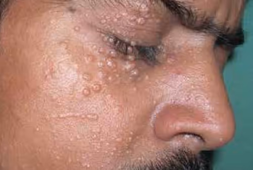 Illustration related to Molluscum Contagiosum