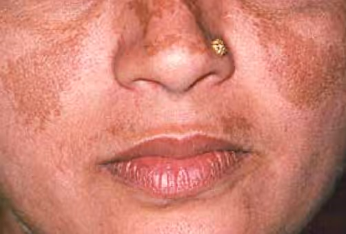 Illustration related to Melasma