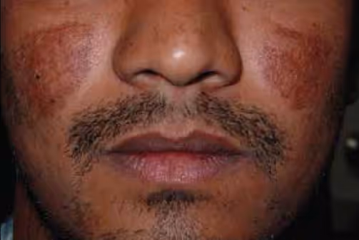 Illustration related to Melasma