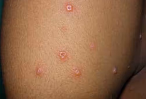 Illustration related to Chicken Pox