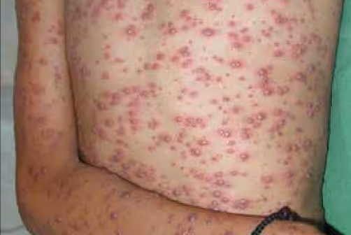 Illustration related to Chicken Pox