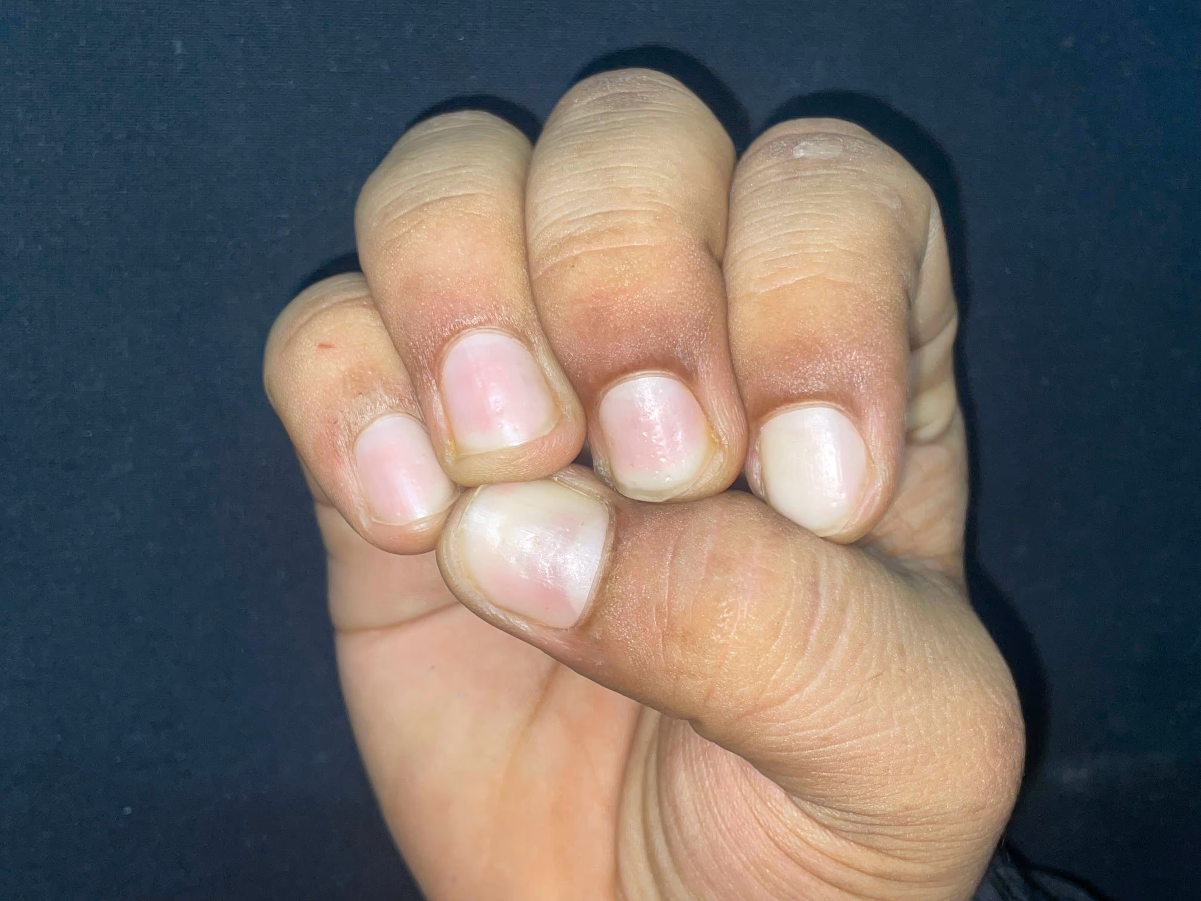 Illustration related to Psoriasis