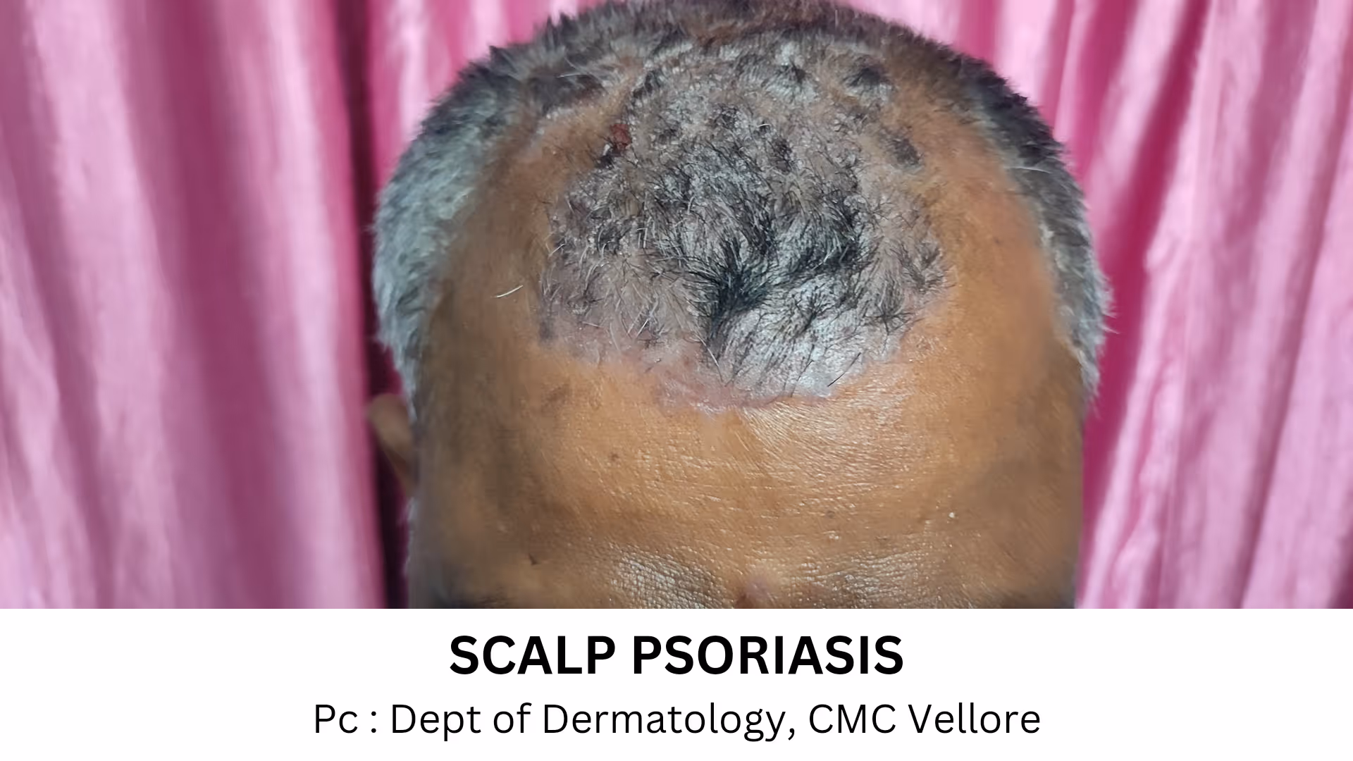 Illustration related to Psoriasis