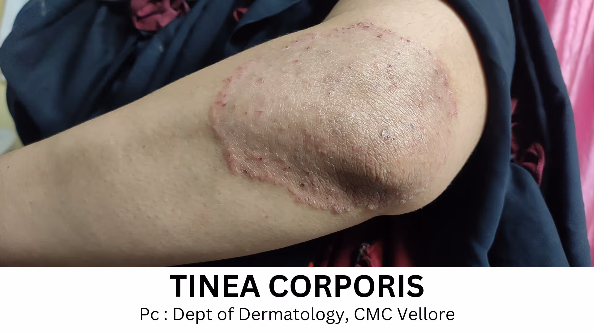 Illustration related to Fungal Skin infection