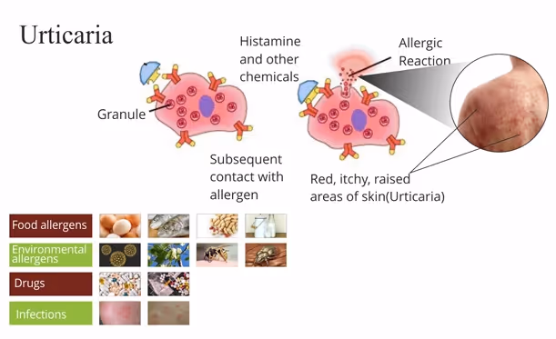Illustration related to Urticaria